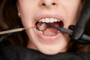 La guía definitiva para prevenir las caries: Consejos y estrategias de expertos