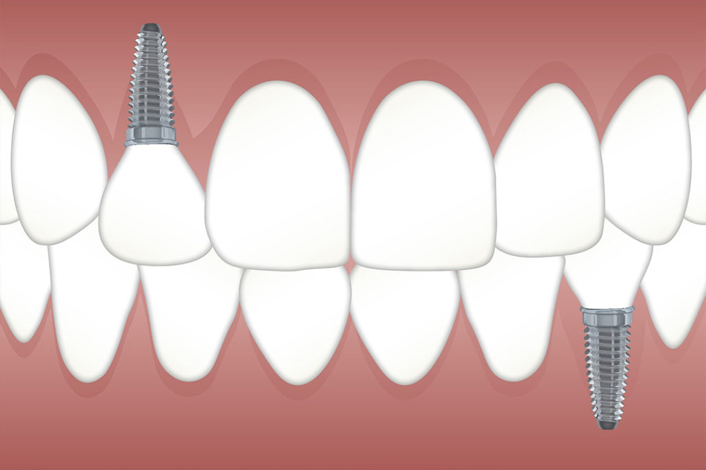 Implantes Clínica Dental Ferdel