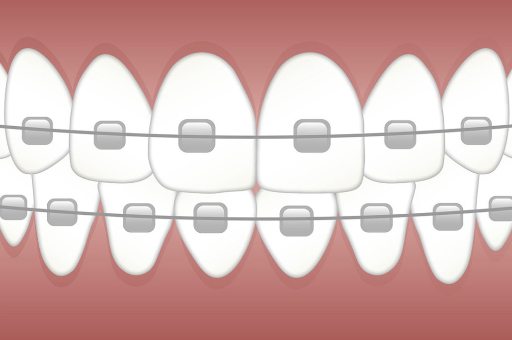 Ortodoncia en Clínica Dental Ferdel